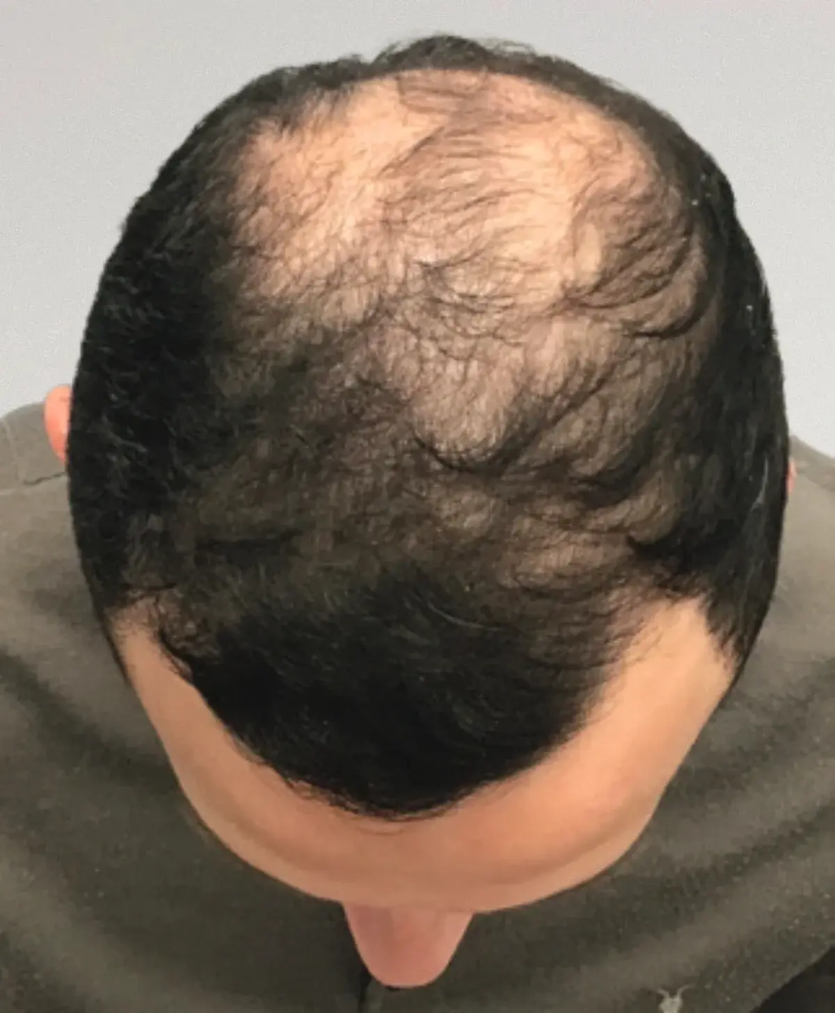 Hair Transplant Solutions in Queensland